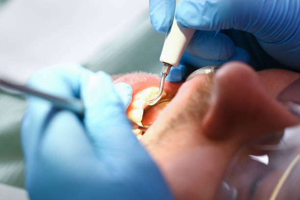 Best Emergency Root Canal Treatment in Mattawan, MI